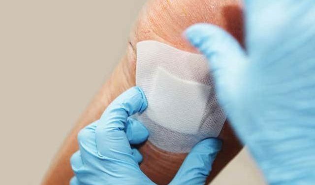 نیلی سبز الجی کے پیوند سے زخم تیزی سے بھرنے لگے